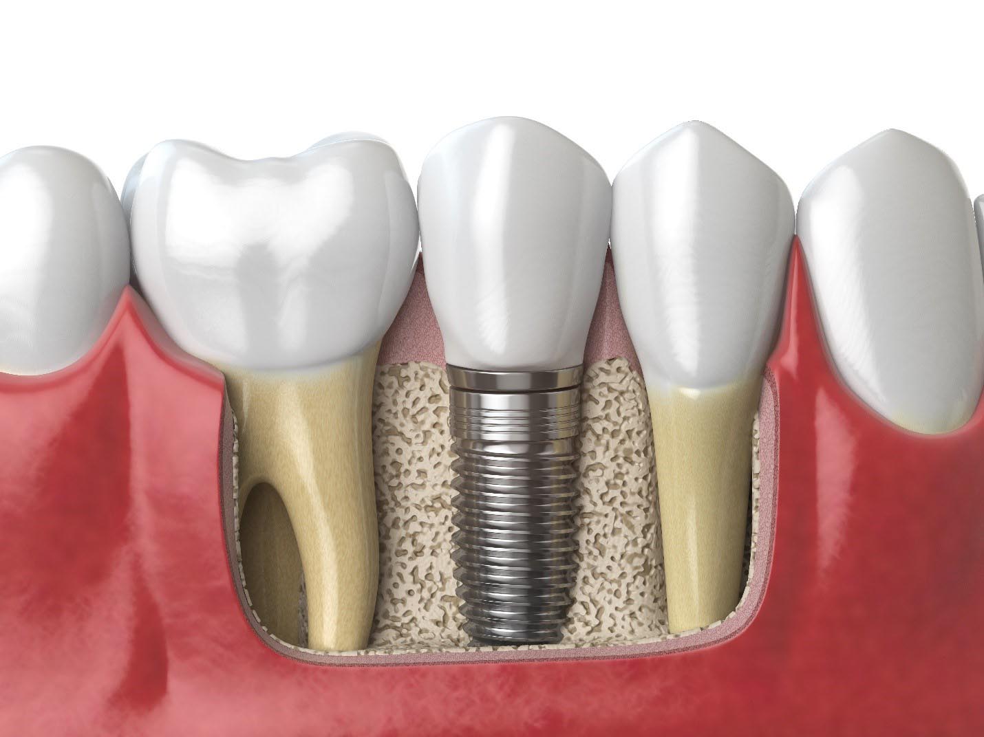 Dental Implants: Costs and What You Need to Know